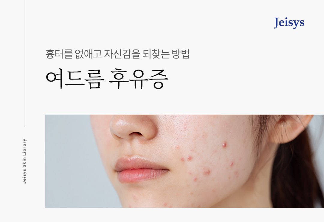 여드름 흉터 메인